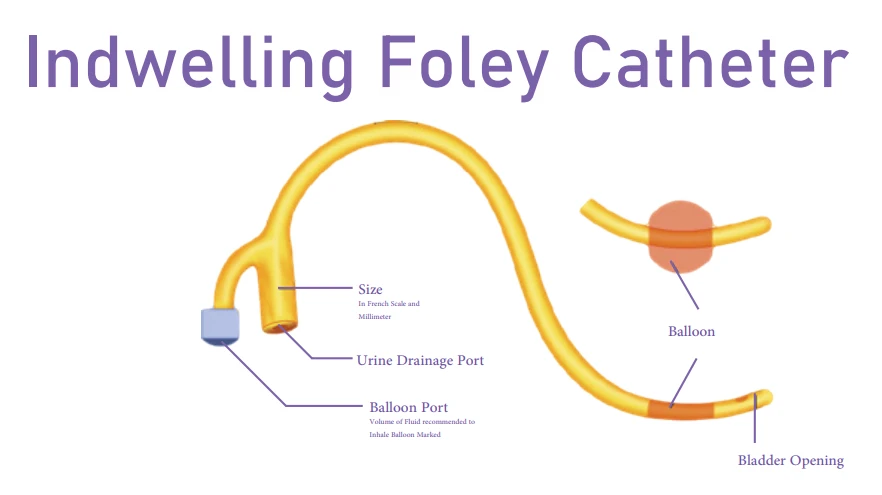 Indwelling Foley Catheter